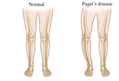 مرض بادجيت (Paget's disease of bone)